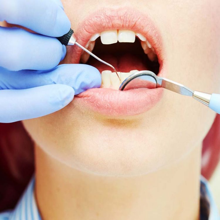 DİŞ TAŞI TEMİZLİĞİ NEDİR?